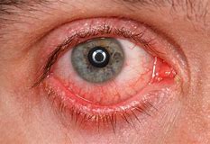 pink eye  